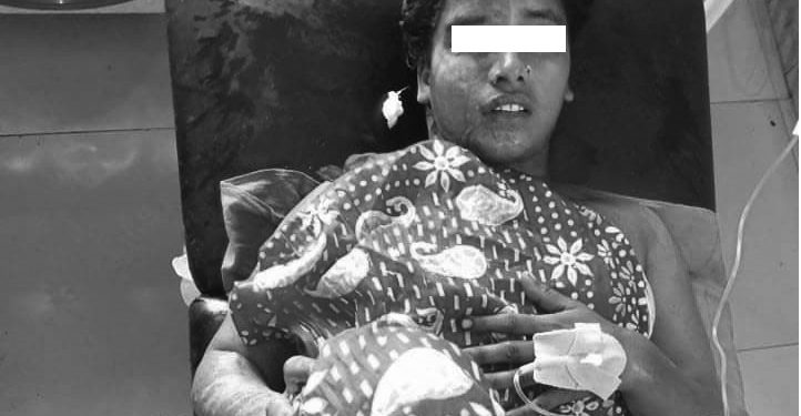 जनकपुरकी एक जना महिलामाथि एसिड प्रहार,महिलामाथि एसिड प्रहार गरेको आरोपमा श्रीमान पक्राउ
