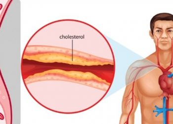 रगतमा कसरी बढ्छ कोलेस्ट्रोल, के गर्ने ? के नगर्ने ? जान्नुहोस्