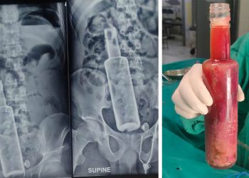 मधेस प्रदेश : पेटभित्र रक्सीको बोतल भेटिएपछि …