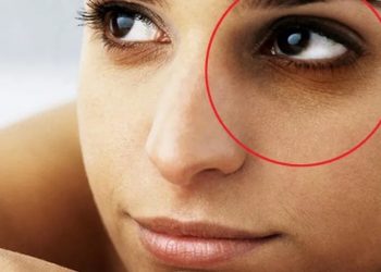 आँखामुनि कालो घेरा (डार्क सर्कल) किन बस्छ ? के छ यसको कारण ? कालो घेरा (डार्क सर्कल) आउन बाट कसरी बच्ने