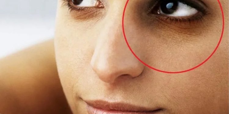 आँखामुनि कालो घेरा (डार्क सर्कल) किन बस्छ ? के छ यसको कारण ? कालो घेरा (डार्क सर्कल) आउन बाट कसरी बच्ने