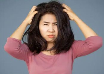 कपालको ड्रैन्ड्रफ हटाउनु छ भने दहीसँग यी समान मिसाएर घरेलु उपचार गर्नुहोस्