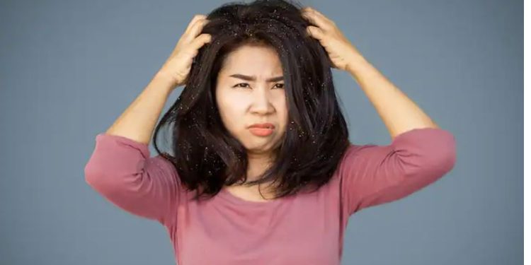 कपालको ड्रैन्ड्रफ हटाउनु छ भने दहीसँग यी समान मिसाएर घरेलु उपचार गर्नुहोस्